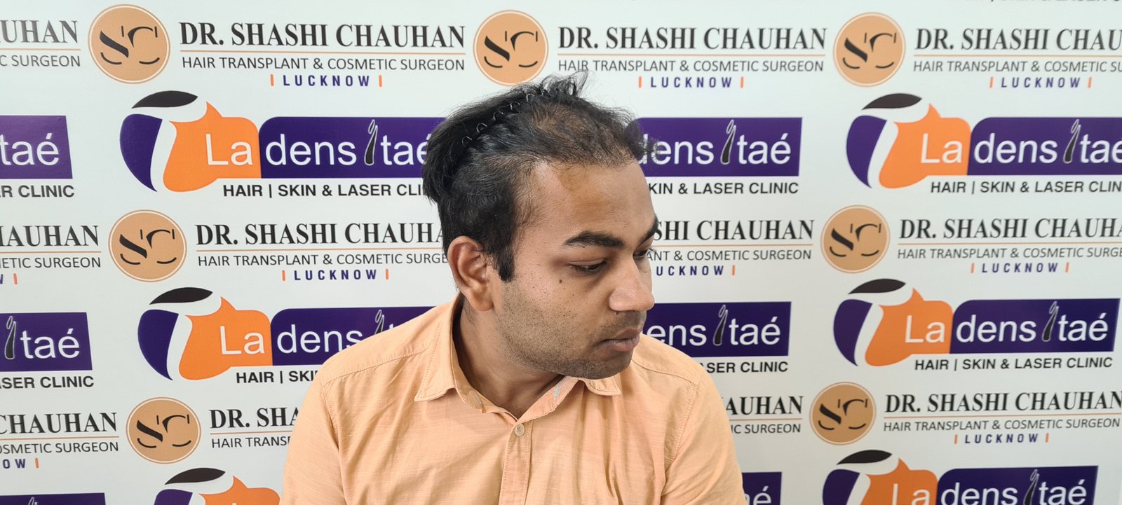 Arnav Dayal Before Hair Transplant